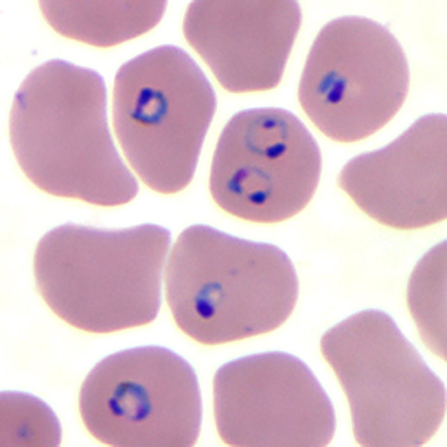 Pink-stained red blood cells, several containing dark-purple ring-form Plasmodium falciparum parasites.