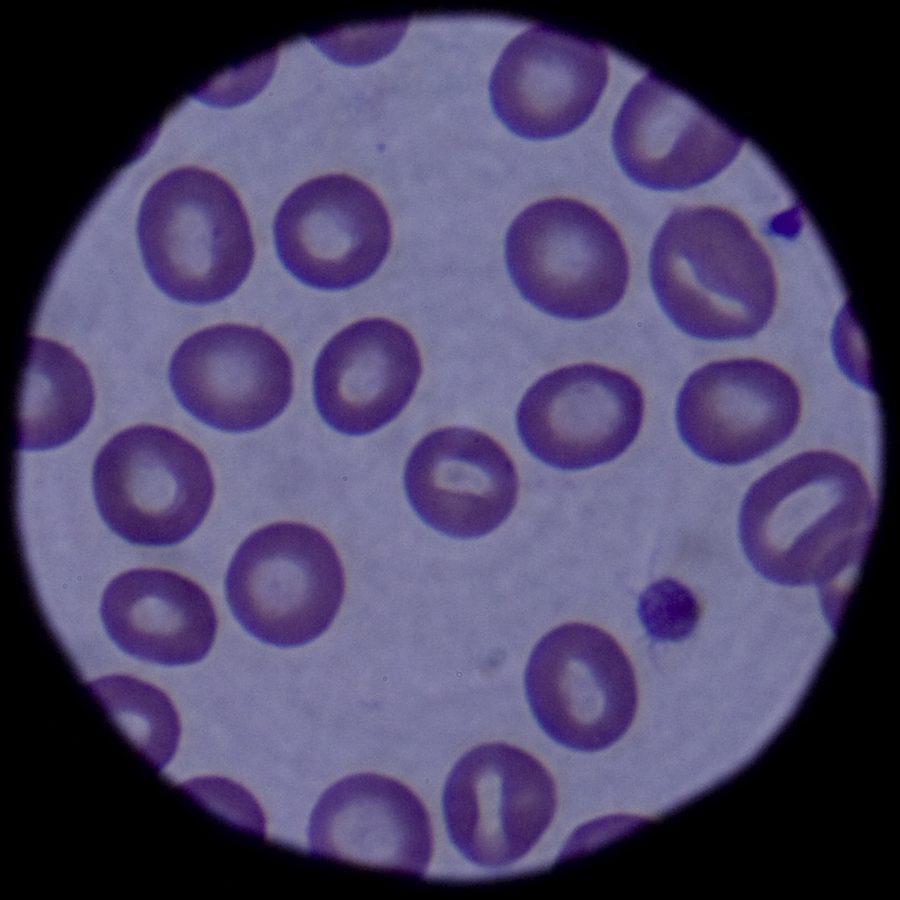 Circular microscope field filled with purple-stained red blood cells and one dark white blood cell.